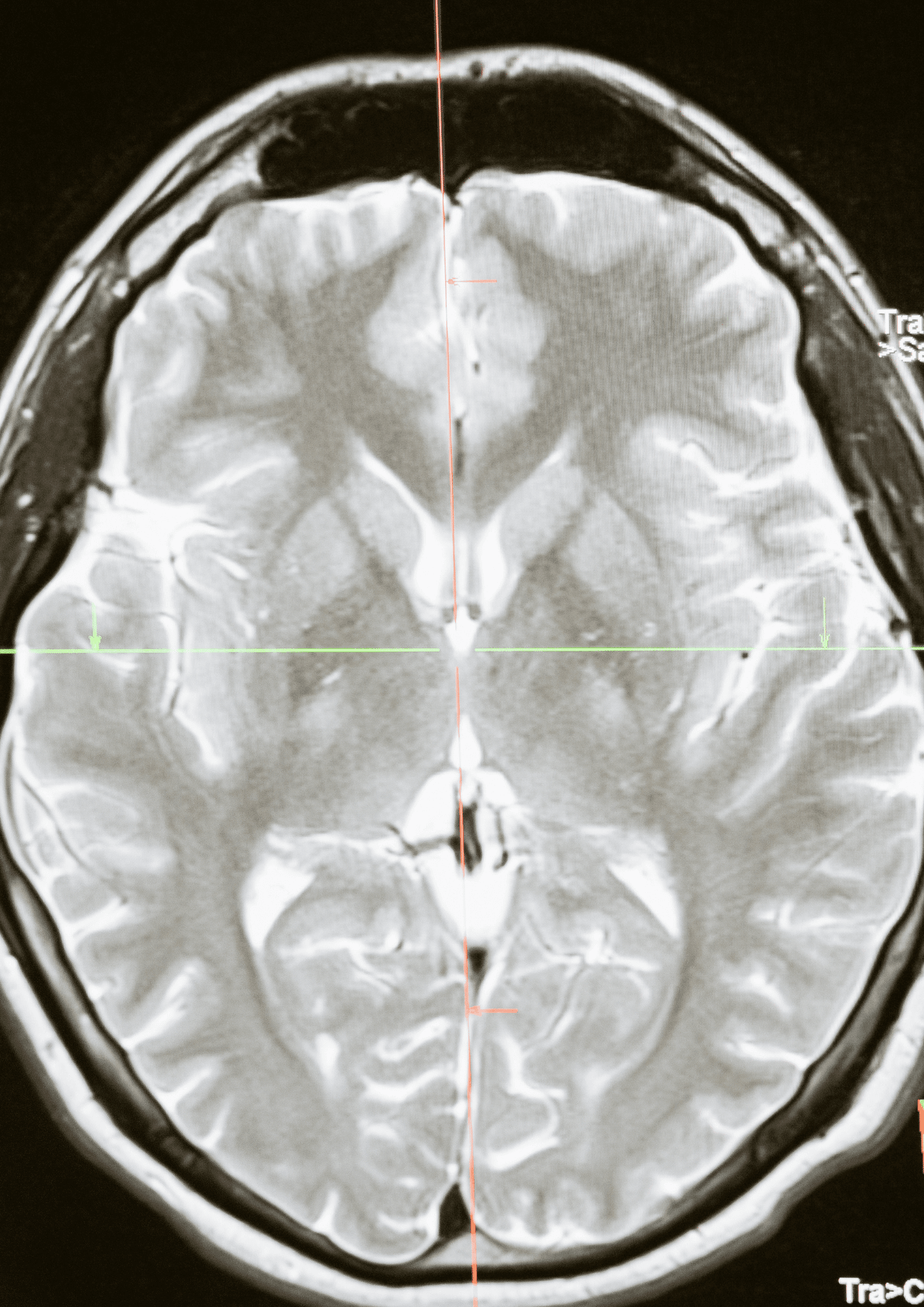 Hyperbaric oxygen therapy, used for brain health support at Biowell